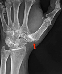 Basilar Thumb Arthritis