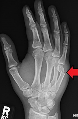 Boxers Fracture