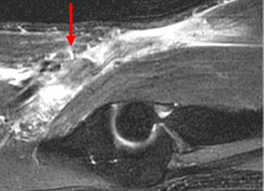 Distal Biceps Rupture