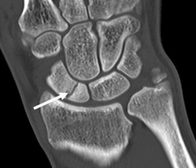 Scaphoid Fracture