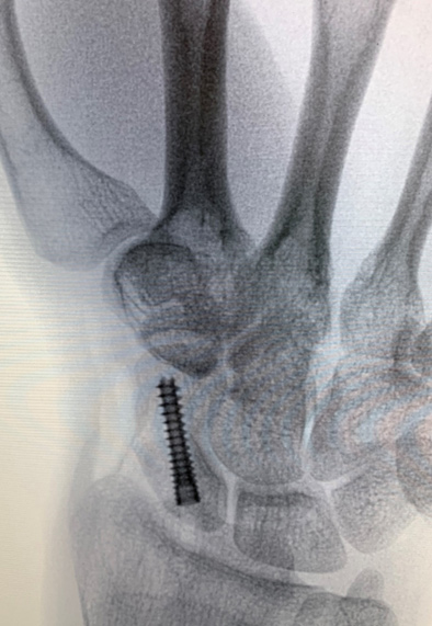 Scaphoid Fracture